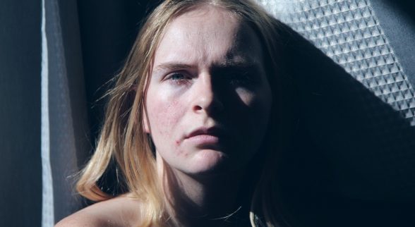 acne punti neri formazione