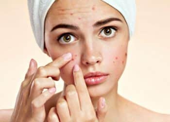 bave di lumache per acne