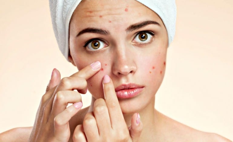 bave di lumache per acne