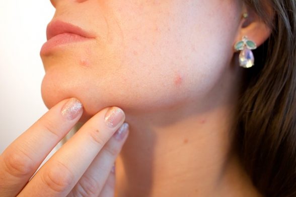 bava di lumaca per cicatrici acne