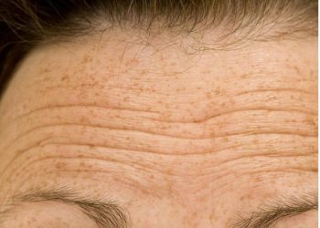 come eliminare le rughe della fronte: rimedi