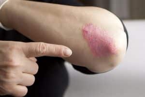 Crema per psoriasi