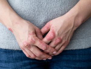 Psoriasi alle mani