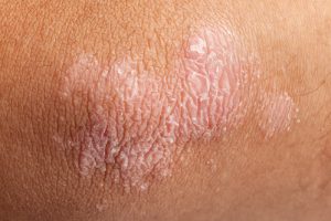 Psoriasi e glutine