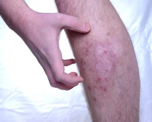 Psoriasi omeopatia