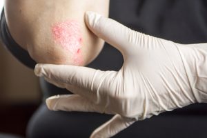 Psoriasi sintomi