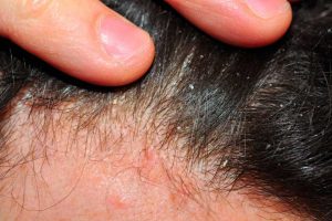 psoriasi del cuoio capelluto
