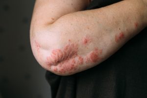 Psoriasi ultime cure