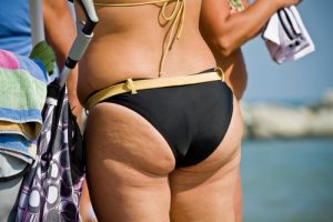 Cellulite cause: come si forma