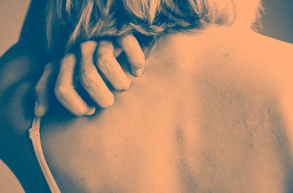 come curare la psoriasi