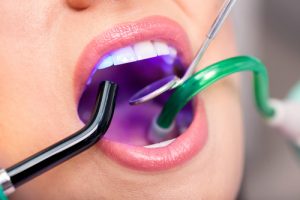 Sbiancamento denti laser
