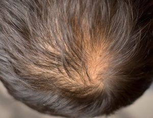 farmaci contro la caduta dei capelli