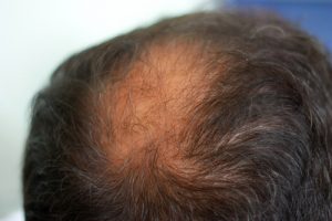 Caduta capelli con bulbo bianco