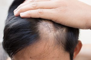 Caduta capelli uomo