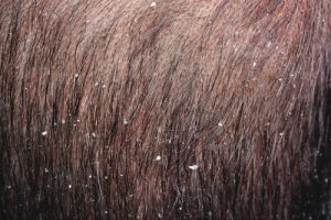 La forfora fa cadere i capelli?